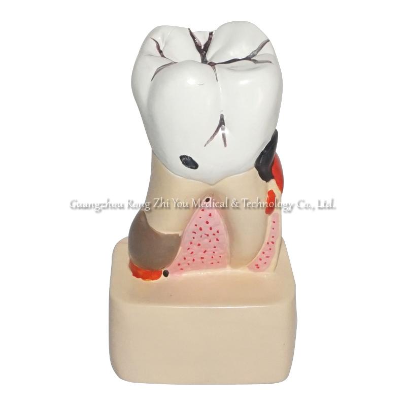 Pathology Dental Model