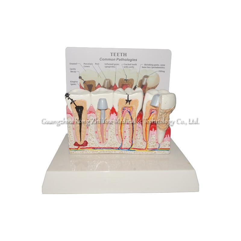 Pathological Teeth Model
