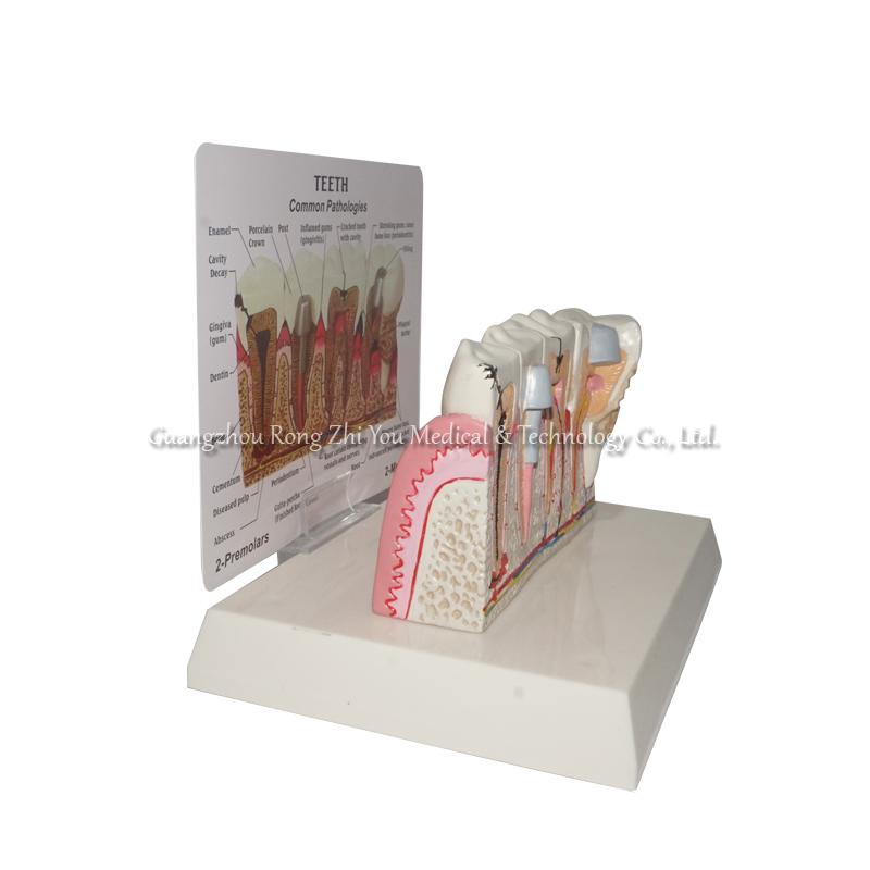 Pathological Teeth Model