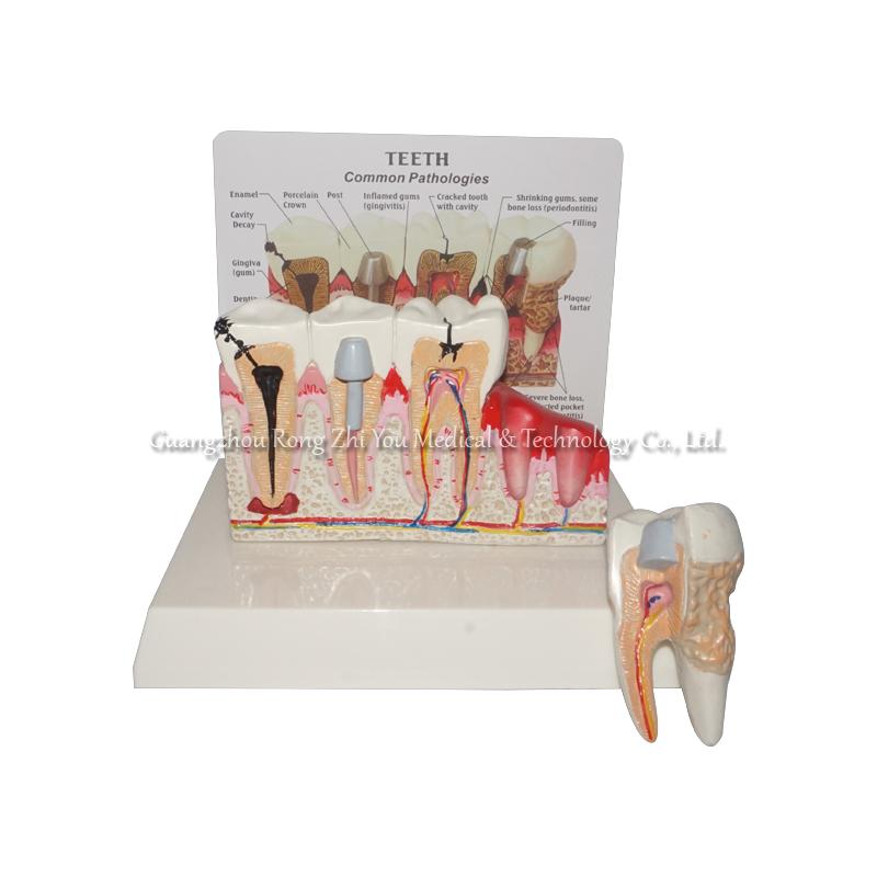 Pathological Teeth Model