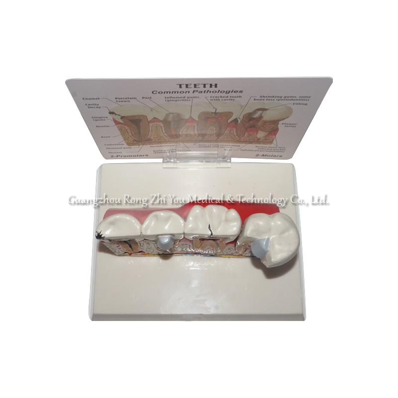 Pathological Teeth Model