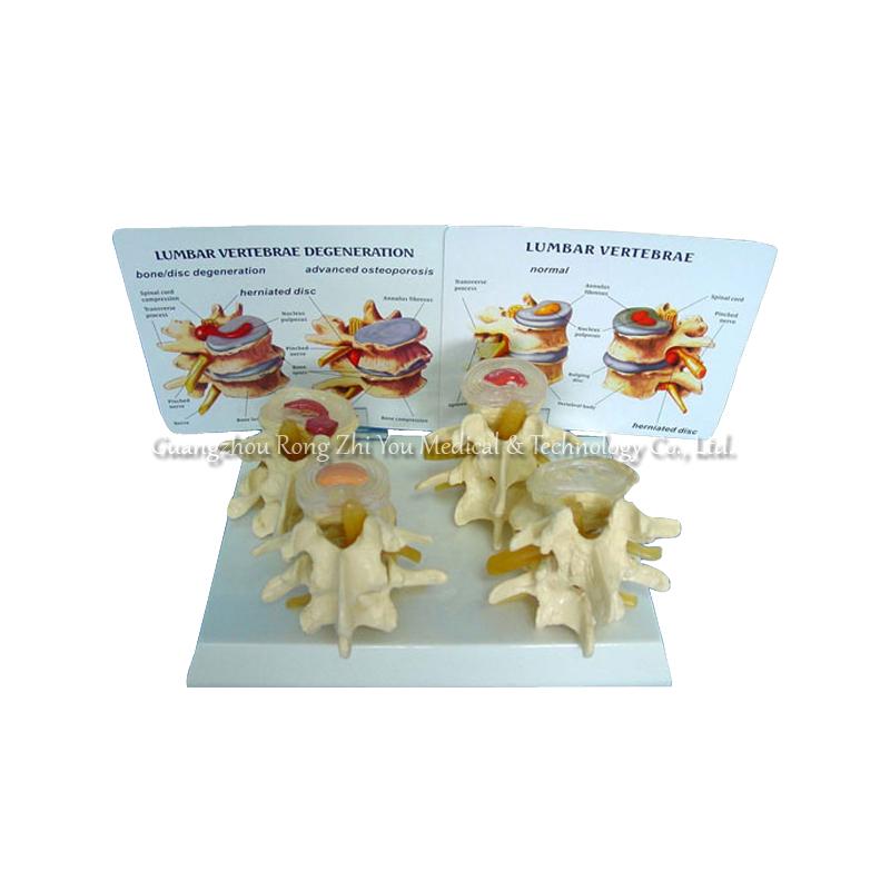 Vertebrae Nomorl Diseaser Composition 