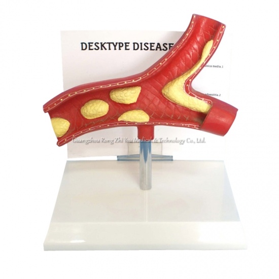 Pathological vascular model