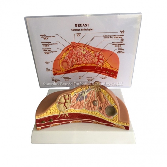 Pathological Breast Anatomical Model