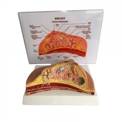 Pathological Breast Anatomical Model