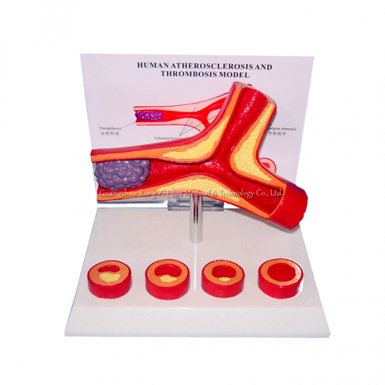 Atherosclerosis Artery Anatomical Model