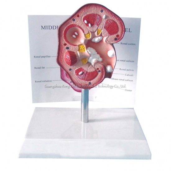Pathological model of renal calculus