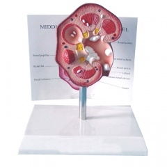 Pathological model of renal calculus
