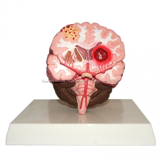 brain stroke demonstration model