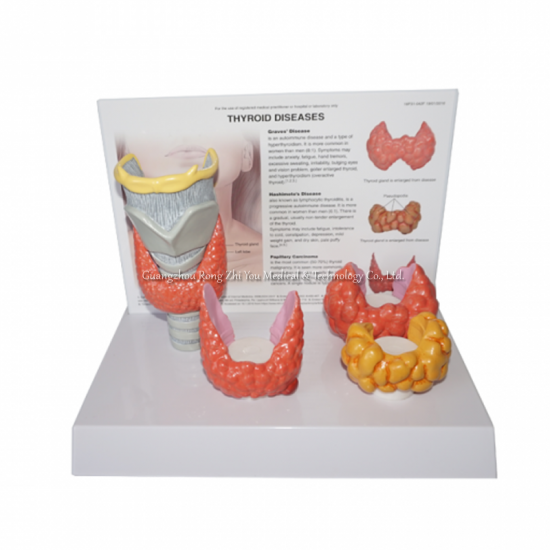 Thyroid Diseases Anatomy Model