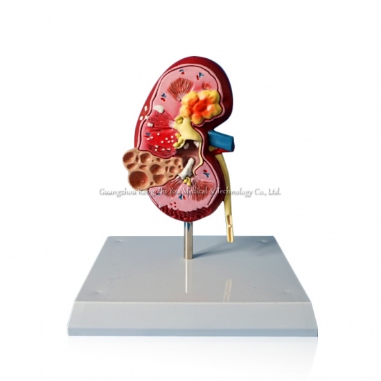 Plastic Kidney Model