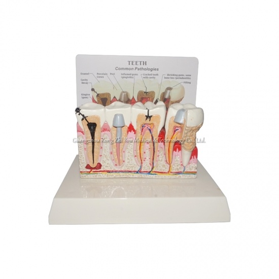 Pathological Teeth Model