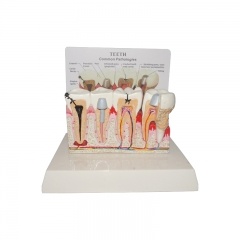 Pathological Teeth Model