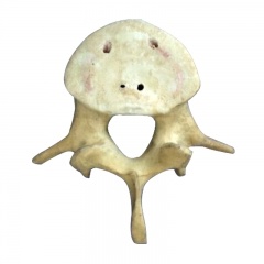 Orthopedic Surgery Practice vertebra Bone