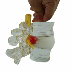 Lumbar Disc Herniation Model