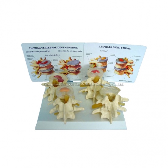 Vertebrae Nomorl Diseaser Composition