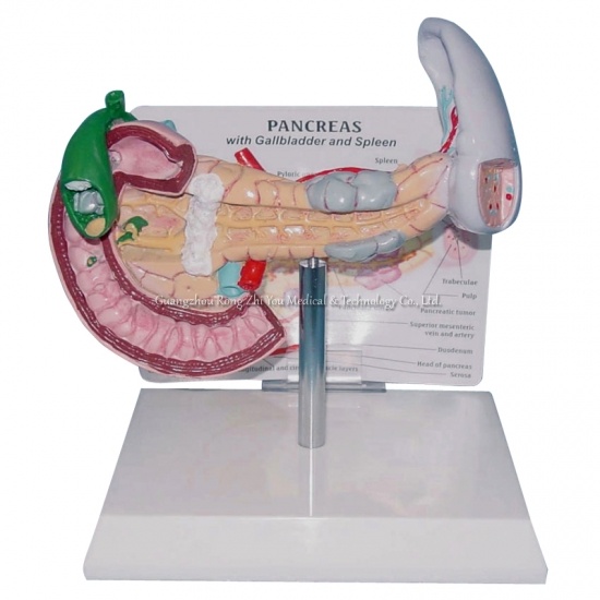 Pathological Model of Pancreas, Duodenum and Spleen