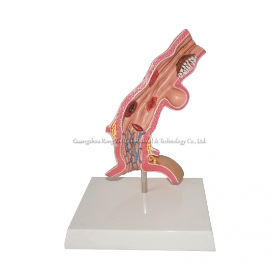 Esophageal Disease Model