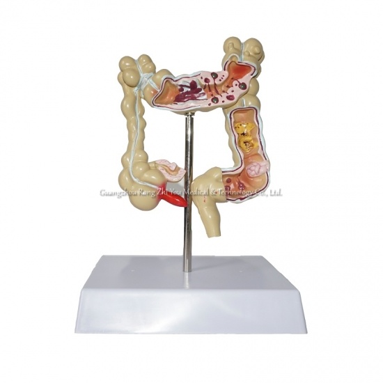 Diseased Colon Model