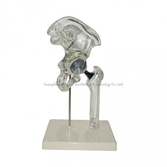 Medical Hip Implant Model