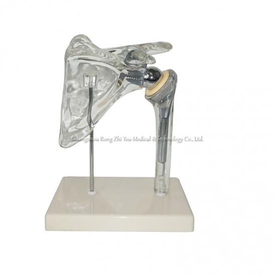 Shoulder Implant Model