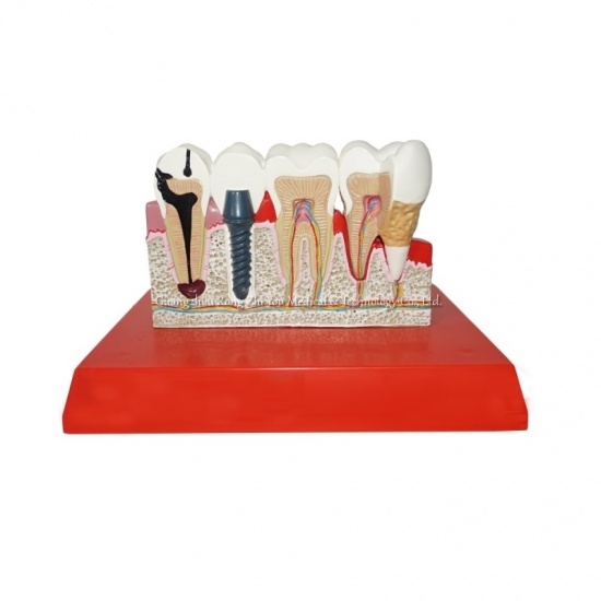 Pathology Teeth Model