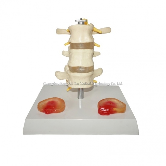 Lumbar Diseased Model