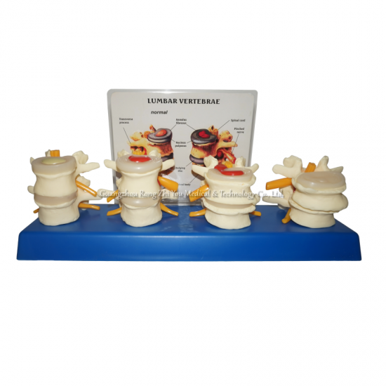 Lumbar Diseased Model