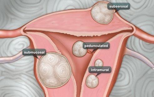 Three types of high-risk groups of uterine fibroids ,Which methods can prevent?